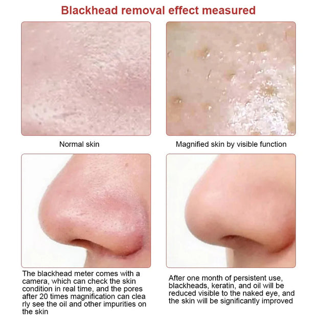 Camera Blackhead Vacuum™